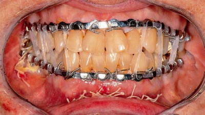 Klinisches Bild einer mandibulo-maxillären Fixation mittels Gummizüge über eine Drahtbogenschienung im Ober- und Unterkiefer