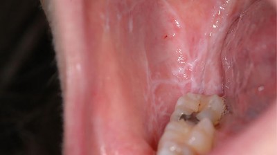 Typische, eher dezent ausgeprägte weißliche, retikuläre Streifen an den Wangeninnenseiten