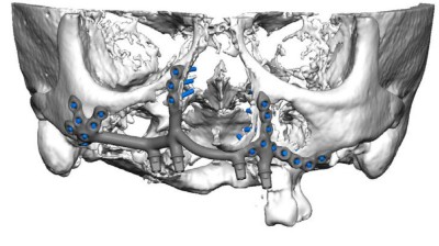 Eingesetztes Individuelles Healing Abutment und Weichgewebsstabilisierung. Das Abutment dichtet die Alveole vollständig ab.