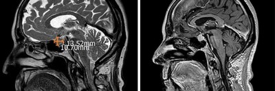 Immunvermittelte Hypophysitis