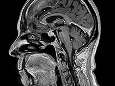 Immunvermittelte Hypophysitis
