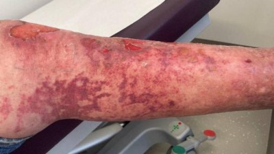 Retiforme Purpura