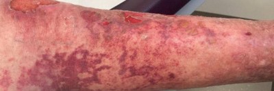 Retiforme Purpura