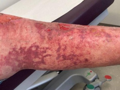 Retiforme Purpura