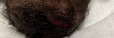 Ausgeprägte fluktuierende okzipitale Schwellung am Kopf eines Babys nach Geburtstrauma