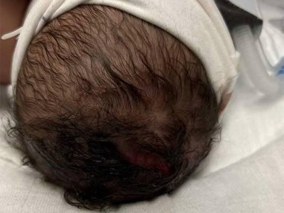 Ausgeprägte fluktuierende okzipitale Schwellung am Kopf eines Babys nach Geburtstrauma
