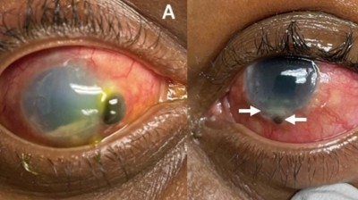 Image from case study_Photo of the eyes with bilateral corneoscleral perforation secondary to ocular tuberculosis