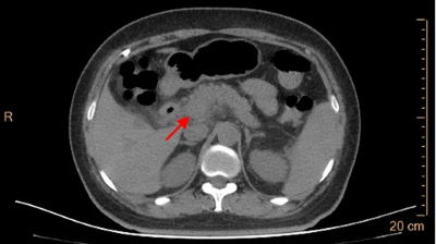 Abdominal CT of SLE patient presenting with acute pancreatitis