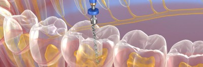 Illustration eines Zahnbogens mit transparenten Zähnen. In einem Zahn wird eine endodontisches Instrument eingeführt