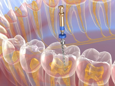 Illustration eines Zahnbogens mit transparenten Zähnen. In einem Zahn wird eine endodontisches Instrument eingeführt