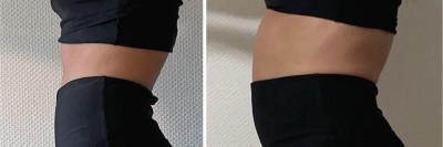 Blähbauch einer Patientin mit retrograder cricopharyngeale Dysfunktion