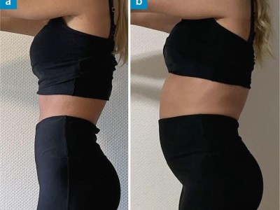 Blähbauch einer Patientin mit retrograder cricopharyngeale Dysfunktion