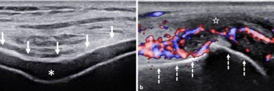 Typische Ultraschallbefunde bei Gichtarthritis