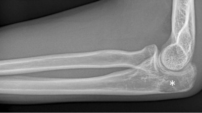 X-ray showing potential osteolysis