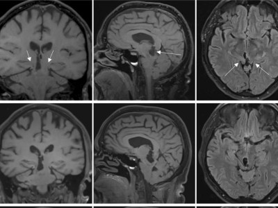 Brain sagging dementia