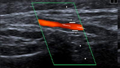 Duplex ultrasound of artery in patient with GCA and aseptic meningitis