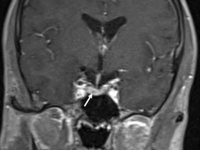 Prolaktinom mit sekundärem hypogonadotropem Hypogonadismus