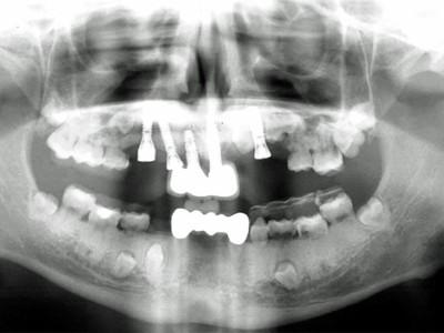 Orthopantomogramm: auf dem Bild sind mehrere Implantate im Ober und Unterkiefer sowie nicht emmergierte Zähne zu sehen