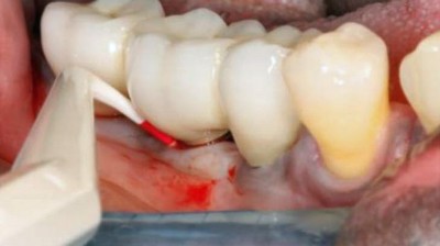 Zahnimplantat Regio 46 mit Sondierungstiefe von 9mm sowie Bleeding on Probing