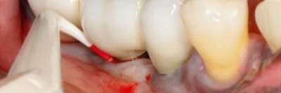 Zahnimplantat Regio 46 mit Sondierungstiefe von 9mm sowie Bleeding on Probing