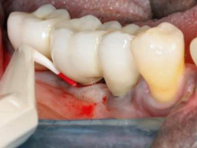 Zahnimplantat Regio 46 mit Sondierungstiefe von 9mm sowie Bleeding on Probing