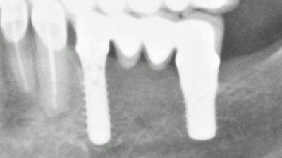 Röntgenbild auf dessen Ausschnitt eine mit zwei Implantaten fixierte Zahnbrücke zu sehen ist