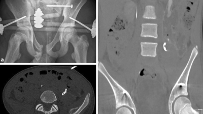 Röntgen einer Beckenfraktur und Abdomen-CT bei Jugendlichem