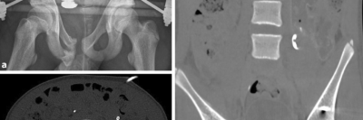Röntgen einer Beckenfraktur und Abdomen-CT bei Jugendlichem