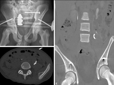 Röntgen einer Beckenfraktur und Abdomen-CT bei Jugendlichem