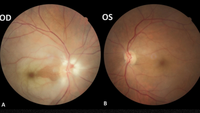 Fundus photography of both eyes in patient with RAO caused by infective endocarditis