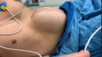 Bauchdeckendefekt nach intraabdomineller Vakuum Behandlung