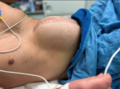 Bauchdeckendefekt nach intraabdomineller Vakuum Behandlung