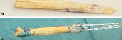 Sehnentransplantate zur Rekonstruktion des vorderen Kreuzbands 