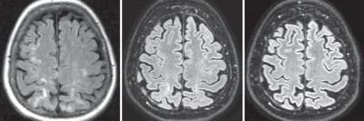 cMRT im Verlauf: reversibles zerebrales Vasokonstriktionssyndrom