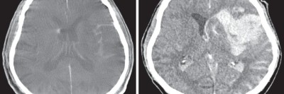 Intrazerebrale Blutung nach mechanischer Thrombektomie