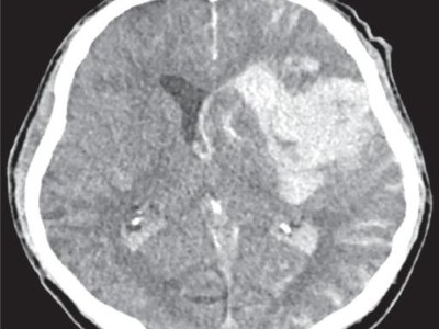 Intrazerebrale Blutung nach mechanischer Thrombektomie
