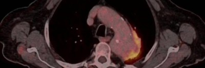 PET-CT Aortenaneurysma