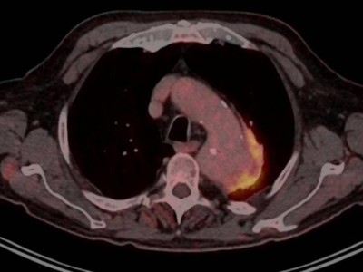 PET-CT Aortenaneurysma