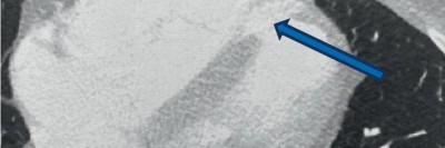 Ventrikelseptumdefekt