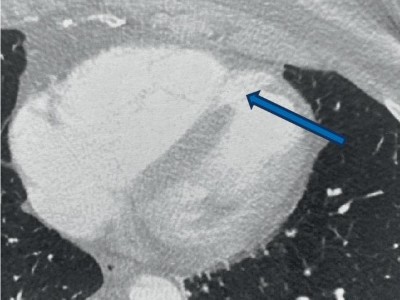 Ventrikelseptumdefekt