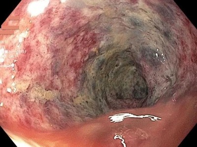 glp-1 constipation lawsuit in west virginia Ozempic GLP-1 Lawsuit & Gastroparesis