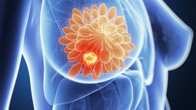Podcast mit Partnern - Exact Sciences GmbH: Brustkrebs-Therapie