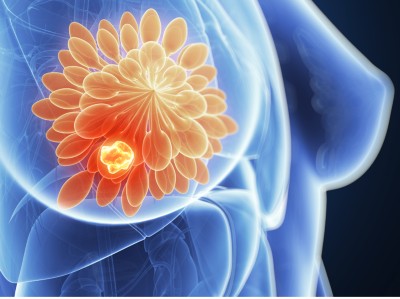 Podcast mit Partnern - Exact Sciences GmbH: Brustkrebs-Therapie