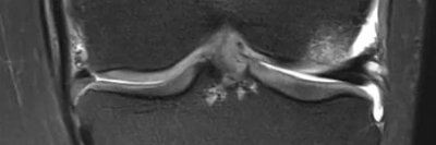  Mediale Meniskusallografttransplantation 