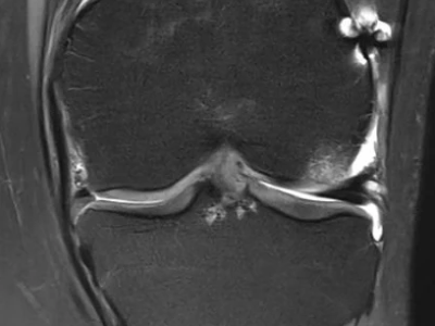  Mediale Meniskusallografttransplantation 