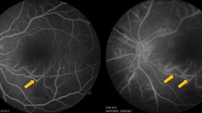 Fundus fluorescein angiogram of SLE patient with retinal vasculitis