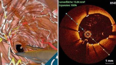 Kohärenztomografie