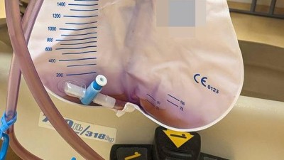Lila-gefärbter Urin in einem Katheterbeutel