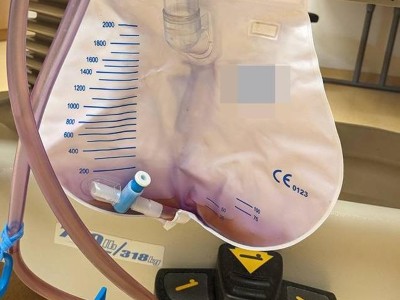 Lila-gefärbter Urin in einem Katheterbeutel