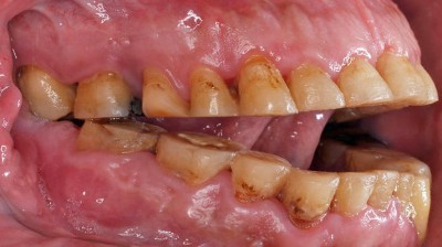 Seitliche Ansicht eines Kiefers in Okklusion: Okklusale Abrasion mit komplettem Verlust der Kaufläche sichtbar
